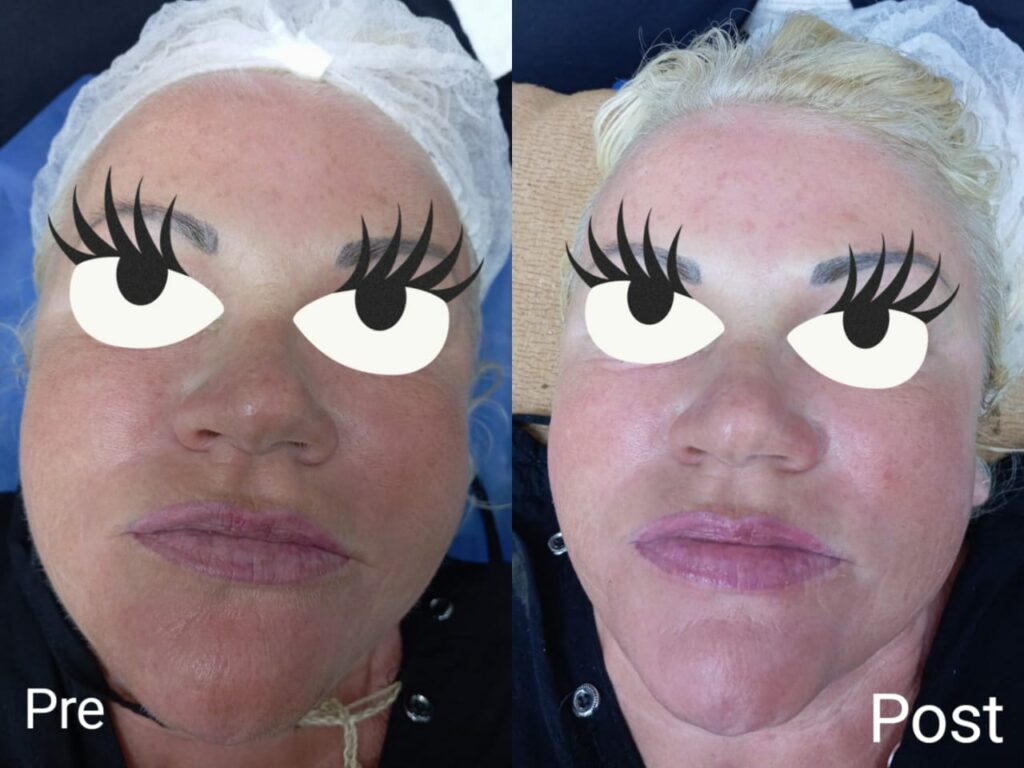 Natoyage skin cleansing session before and after